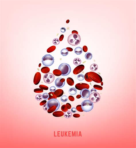 Infographic Image Of Leukemia Leukaemia Disease Awarenessrealistic