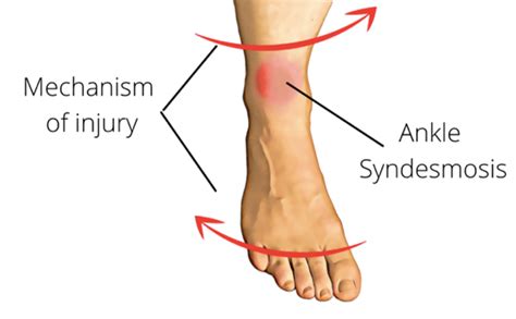 Focus On High Ankle Sprains Rural Physio At Your Doorstep