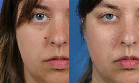 Facial Mole Removal San Diego Ca