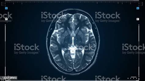 Brain Mri Scan Scanning Of Brains Magnetic Resonance Image Diagnostic