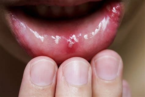 Mouth Sores And Inflammation Of The Oral Mucosa Causes Symptoms And