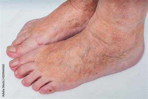 Varicose Veins On The Feet Of An Elderly Woman Inflamed Dilated Veins