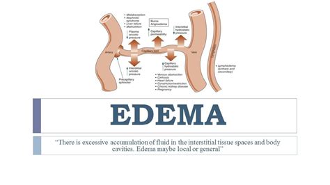 Edema Types Grading Cause Pathophysiology Treatment