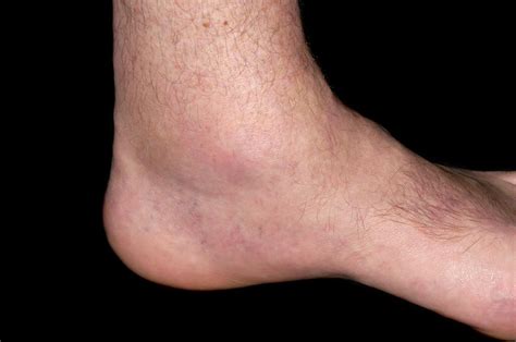 Gout Of The Ankle Photograph By Dr P Marazzi Science Photo Library My
