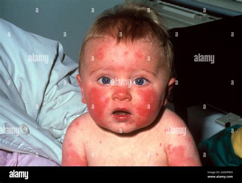 Fifth Disease Red Rash On An Infants Face And Arms Known As Slapped