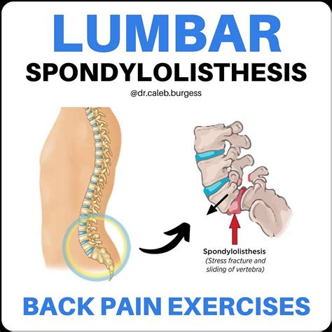 Lumbar Spondylolisthesis Back Pain Exercise Save This Thread From