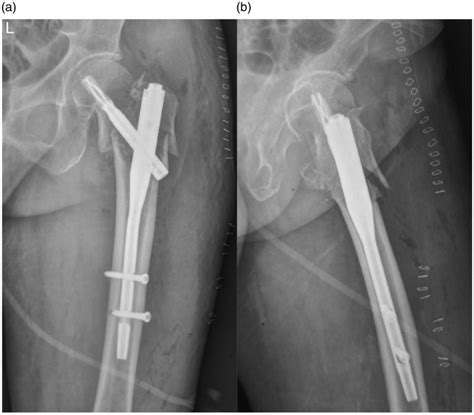 Plain Radiographs Demonstrating A Left Intertrochanteric Femoral