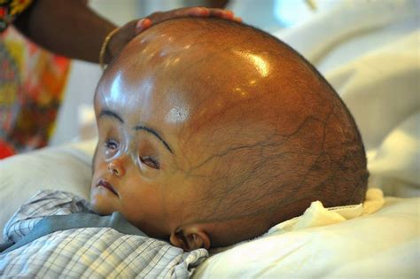 Hydrocephalus Causes Symptoms And Prevention Publicwellness Group