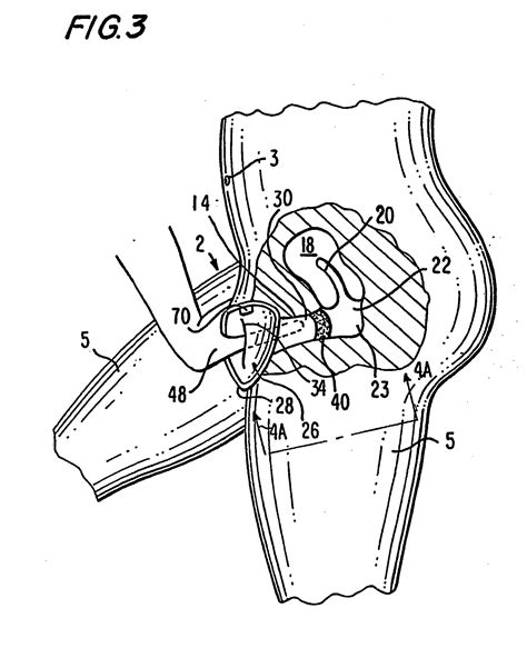 Patente Ep1804748b1 Contraceptif Feminin Equipe Dun Ancrage A Vide
