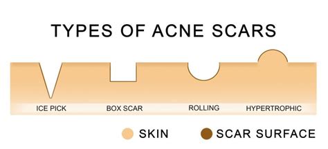 How To Identify What Sort Of Scars You Have And What That Means For