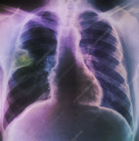 Lung Abscess X Ray Stock Image C0095393 Science Photo Library