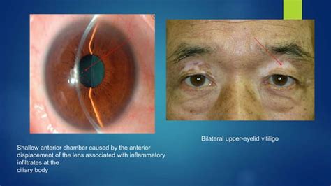Sympathetic Ophthalmia And Vkh Syndrome Ppt