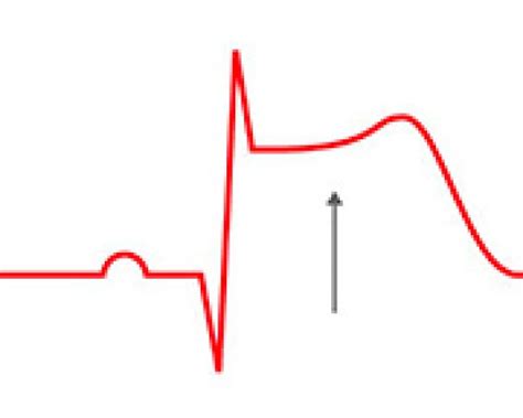 Infarctus Aigu Du Myocarde Lélectrocardiogramme Pour Confirmer Le Diagnostic Medipedia