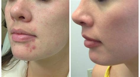 A Real Patients Experience With Isotretinoin Ren Dermatology