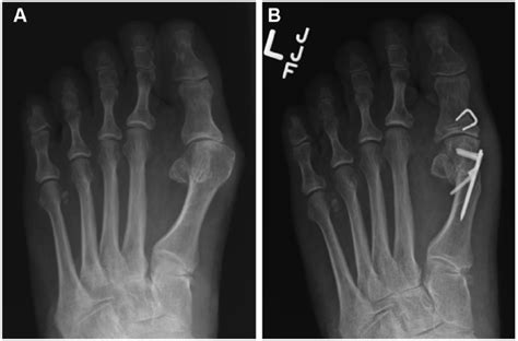 Short Term Radiographic Outcome After Distal Chevron Osteotomy For
