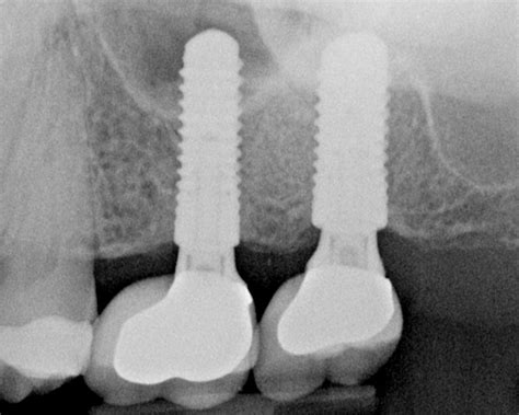Should Molar Implant Restorations Be Cemented Spear Education