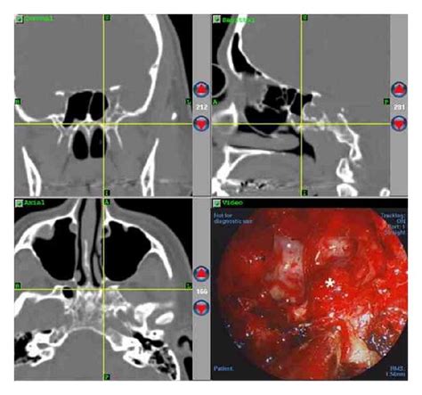 Intraoperative Endoscopic View Of The Lesion With Real Time Ct Guided