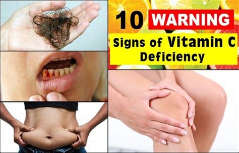 10 Common Symptoms Of Vitamin C Deficiency Fastnewsfeed