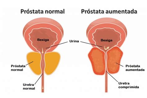 Cancer De Prostata Deixa O Homem Impotente