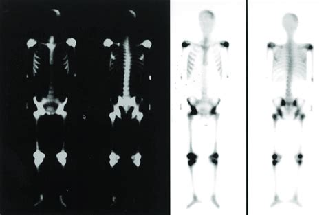 Tc 99m Mdp Bone Scintigraphy Showed Increasing Osteoblastic Activity In