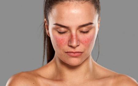 Systemic lupus erythematosus, sjogren syndrome, and mixed connective tissue disease in children and adolescents. Systemischer Lupus erythematodes: Symptome, Behandlung ...