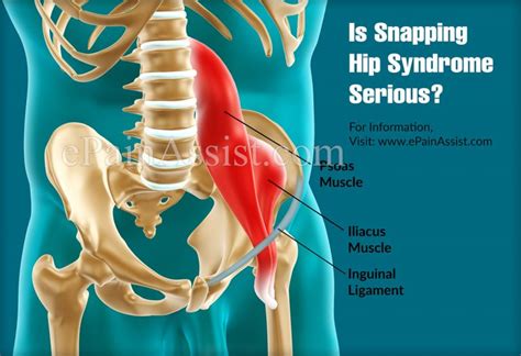 Hip Injuriesbursitisdislocationspraintendonitisfracturesnapping