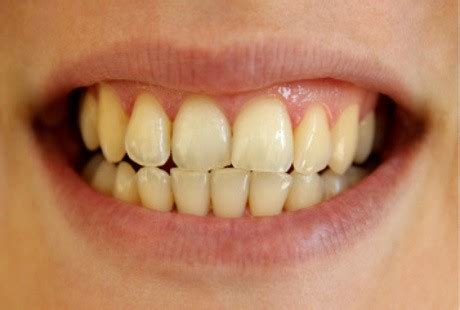 Gigi Yang Berwarna Kuning Apakah Tanda Gigi Yang Tidak Sehat