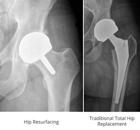 Hip To It What Runners Should Know About Hip Replacement Options Laptrinhx News