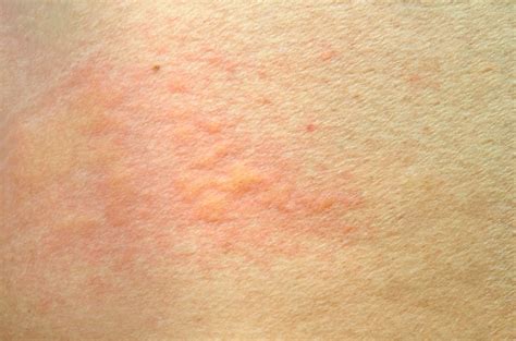 Grattez La Peau Allergique Des Piqûres De Moustiques Ou Dinsectes