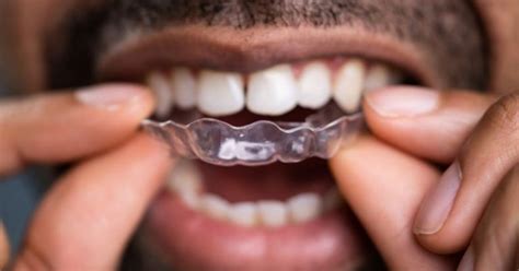 Invisalign Braces Cost Reviews Before And After