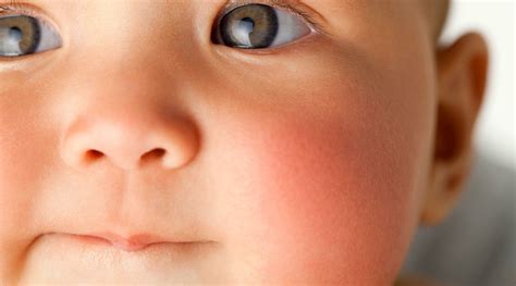 Rashes And Skin Problems In Babies