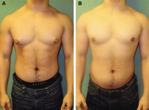 Images Before A And After B Gynecomastia Surgery In A Patient Who