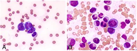 Peripheral Blood Smear And Bone Marrow Aspirate A Peripheral Blood