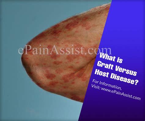 What Is Graft Versus Host Disease And How Is It Treated Causes