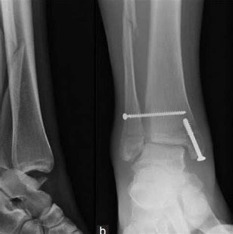 Syndesmosis Injury High Ankle Sprains Watsonia Podiatry