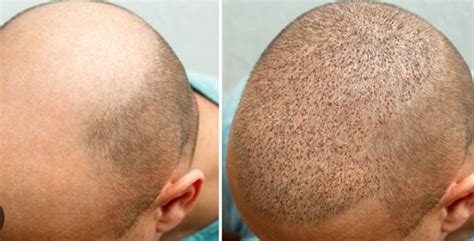 Oxycure Technique A Paradigm Shift In Hair Transplant Survival Rates