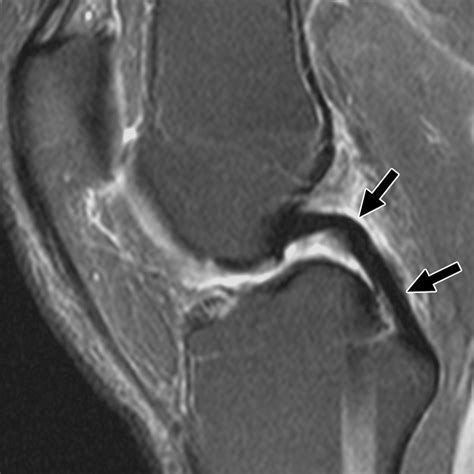 Mri Appearance Of Posterior Cruciate Ligament Tears Ajr