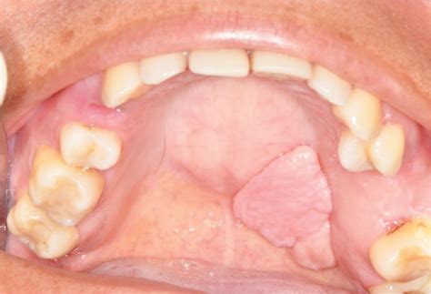 Leaf Like Traumatic Fibroma In A Dentate Patient An Unusual Case
