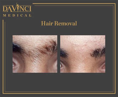Da Vinci Clinic Permanent Hair Removal Using Fotona Sp Dynamis Pro Laser