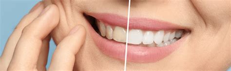 Teeth Whitening At The Dentist Dental World Marietta GA