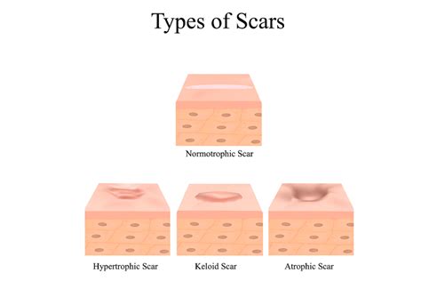 Acne Scars 3 Types Of Scars And The Recommended Treatments