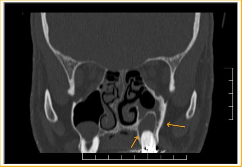 Odontogenous Maxillary Sinusitis Ct Sumers Radiology Blog