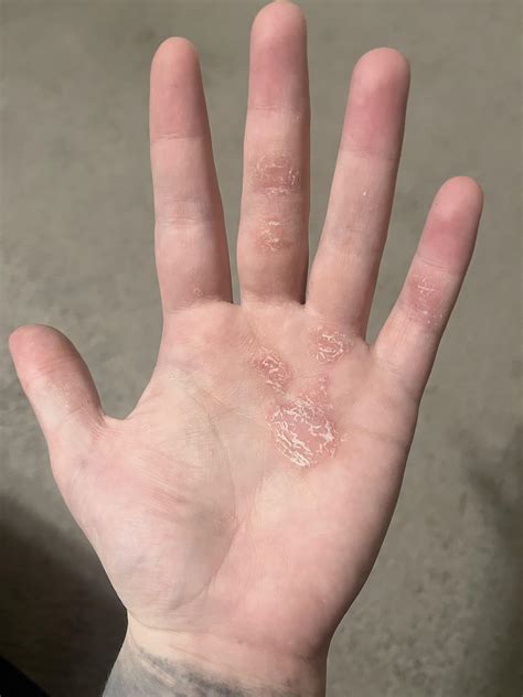 Dry Skin Patches On Hands Nothing Seems To Help Rskincareaddiction