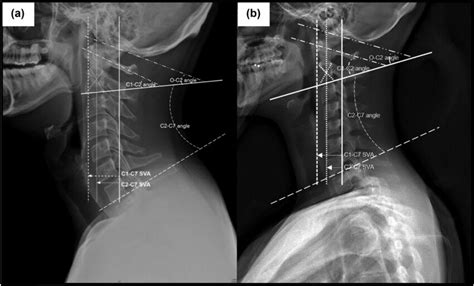 Parameters Of Sagittal Cervical Alignment On Plain Radiographs A The