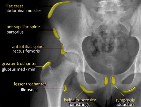 The Radiology Assistant Hip Pathology In Children