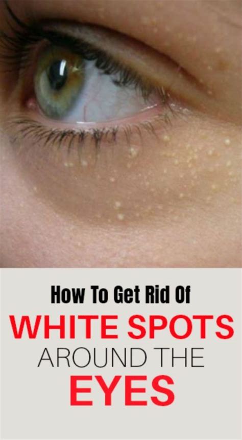 How To Get Rid Of White Spots Around The Eyes Creativity1 Skin Tag