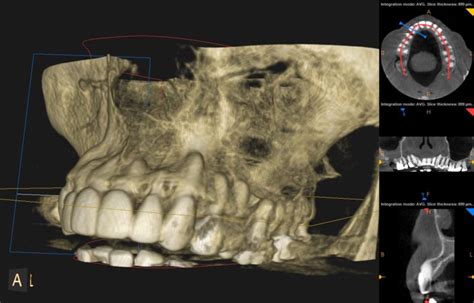 Why CBCT Cone Beam CT Scan Is A Must For Patients Receiving Dental