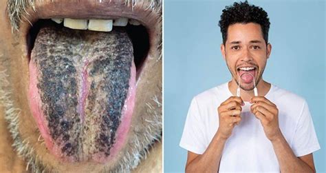 Why A Mans Tongue Turned Black And Hairy Following A Stroke