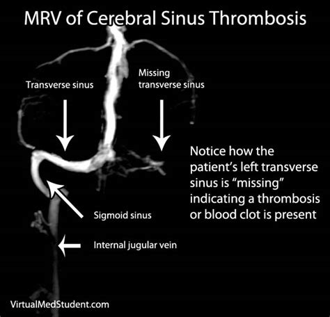 Review of the scientific literature. Sinus Thrombosis, Intracranial; Cranial Sinus Thrombosis ...