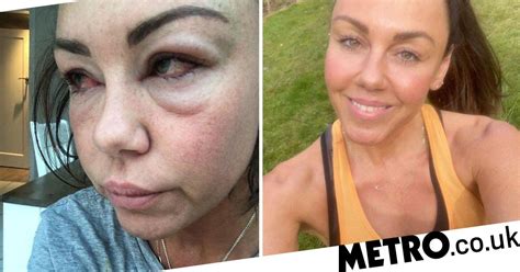Michelle Heaton Shares Shocking Photos Of Alcoholism To Help Others